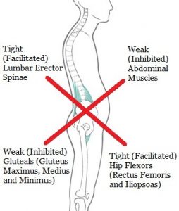 Illustration of Lower Cross Syndrome posture