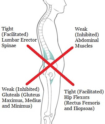 Lower Cross Syndrome