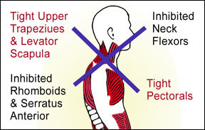 Janda's poor posture theory of hypo and hyper tonic muscles