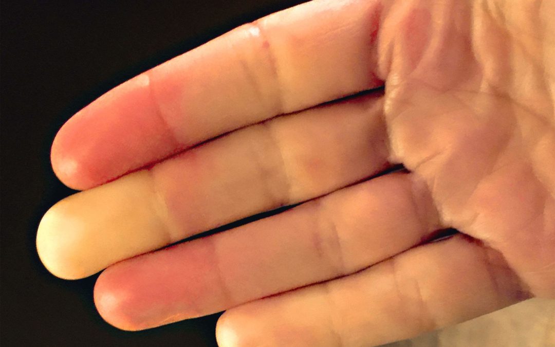Suffering from Raynaud’s disease?