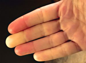 Suffering from Raynaud's?